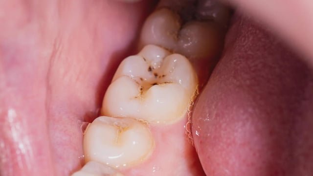 ¿Adiós, caries? Un nuevo gel podría regenerar el esmalte dental